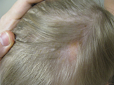 Discrete areas of hair loss - The Clinical Advisor