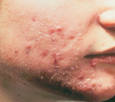 Pseudofolliculitis Barbae Treatment