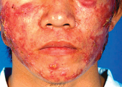 acne vulgaris severe