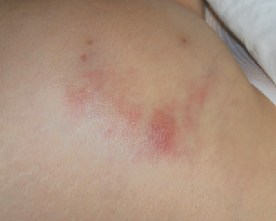 Recurrent cellulitis following buttock augmentation - MPR