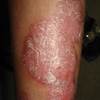 A short course in topical psoriasis agents A short course in topical psoriasis agents