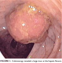 Gastroenterology searches for cause of patient's anemia
