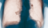 A larger role for PCPs in COPD management