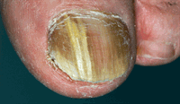 Yellow, thickened toenail caused by onychomycosis