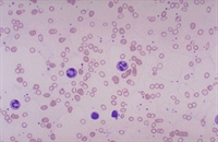 Figure 2. Microcytic, hypochromic RBCs in a patient with iron deficiency anemia