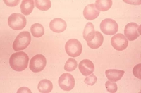 Figure 3. Macrocytic, ovalocytic red blood cells in a patient with megaloblastic anemia (vitamin B12 deficiency)