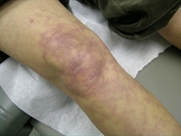 Annular purpuric rash on the lower extremities