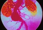 Smoking propels aneurysm risk in women Smoking propels aneurysm risk in women