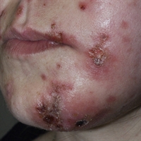 Standard of care for MRSA infections