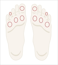 Figure 2. Semmes-Weinstein monofilament test sites