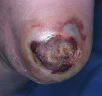 Close-up of a resolving ulcer on the heel of a diabetic patient