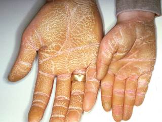 Hyperkeratotic plaques that run in the family Hyperkeratotic plaques that run in the family