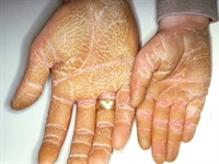 Hyperkeratotic plaques that run in the family 