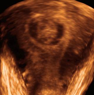 Assessing excessive menstrual bleeding Assessing excessive menstrual bleeding