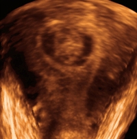 Assessing excessive menstrual bleeding