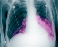 Figure 2. Lung x-ray shows pneumonia (purple).