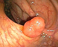 Colon polyps may be removed at the time of colonoscopy.