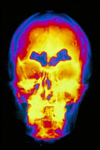 Sinusitis (blue) usually results from bacterial infection of the mucous membrane.