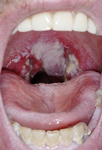 infections in adults Throat