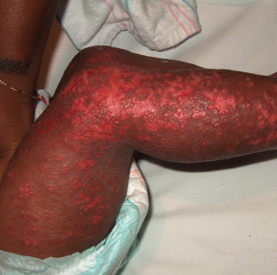 Nummular eczema topical steroid withdrawal