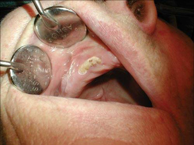 Figure 2. Osteonecrosis of the jaw's maxillary arch
