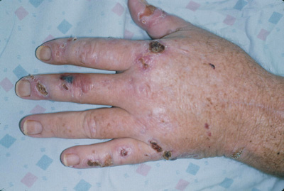 sores on hands #11
