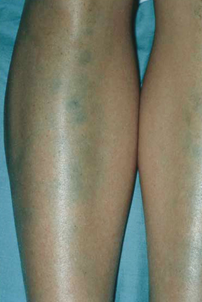 pigmentation-on-the-legs-of-a-young-female-athlete-the-clinical-advisor