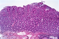 Photomicrograph of celiac disease showing complete atrophy of the duodenal villi.
