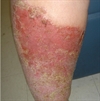 Two erythematous leg rashes 
