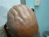 Thick ridges and valleys found on a newly shaved scalp
