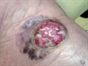 A pair of solitary nodules