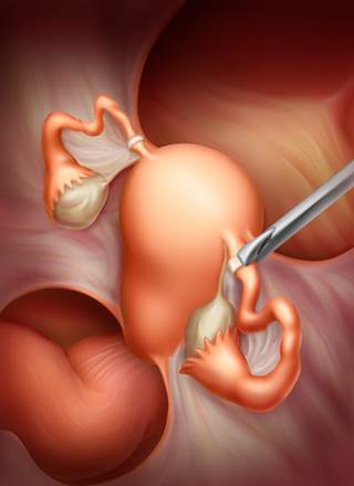 In tubal ligation, the fallopian tubes are cut and tied to prevent eggs from reaching the uterus. In tubal ligation, the fallopian tubes are cut and tied to prevent eggs from reaching the uterus.