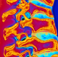 Decreased bone density causes vertebral bones (orange) to appear wedge-shaped.