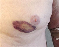 Peculiar violaceous, atraumatic rash
