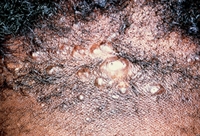 Increasing scalp rash blamed on a haircut