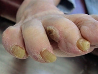 Painful pedal lesions