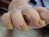 Painful pedal lesions