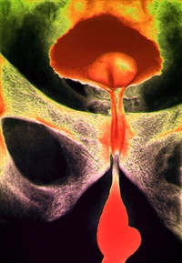 Benign prostatic hyperplasia may cause stenosis of the urethra