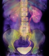 A right kidney stone as seen on abdominal CT