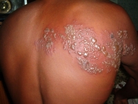 Vesicles and crusts of herpes zoster on an erythematous base