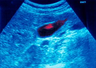 Gallbladder wall polys (red) have been associated with abdominal pain and dyspeptic symptoms Gallbladder wall polys (red) have been associated with abdominal pain and dyspeptic symptoms
