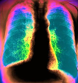 X-ray showing acute miliary TB reveals many fine micronodules X-ray showing acute miliary TB reveals many fine micronodules