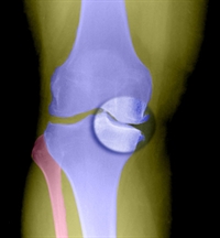 X-ray shows joint-space narrowing in a knee with osteoarthritis
