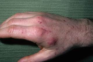 Psoriasis From A Cat Scratch Psoriasis From A Cat Scratch