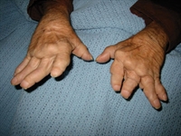 Figure 2. The patient also had arthritis mutilans of the hands.