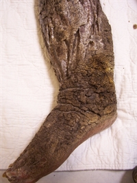Intractable bilateral leg swelling and recurrent infections