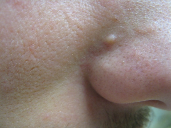 fibrous papules of the nose #10