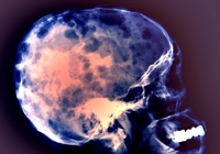 Myeloma replaces cells in the marrow, leaving the appearance of holes in the bone