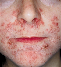 Months-long facial rash with constant burning sensation