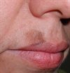 Solar lentigo and lentigo maligna melanoma: itchless, pigmented macules